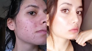 Tretinoin Before and After 12 Tips To Get The BEST RESULTS [upl. by Martens]