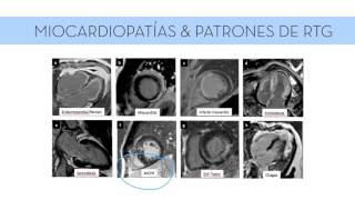 Resonancia Magnética Cardíaca [upl. by Ainez]